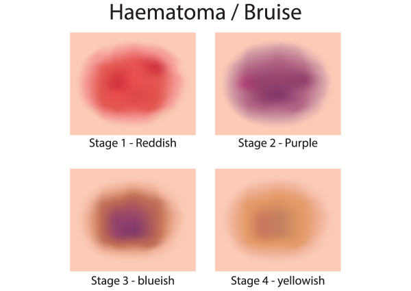 Hematomas 2B - Bruises 2B – Kitchen Makeup